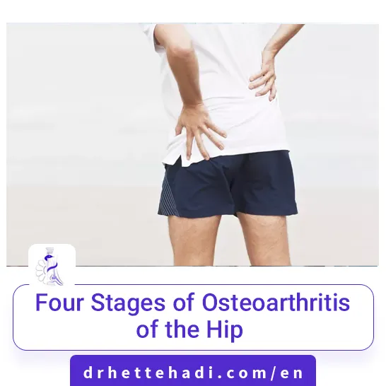 Four Stages of Osteoarthritis of the Hip