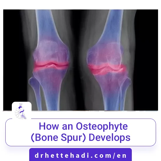 How an Osteophyte (Bone Spur) Develops