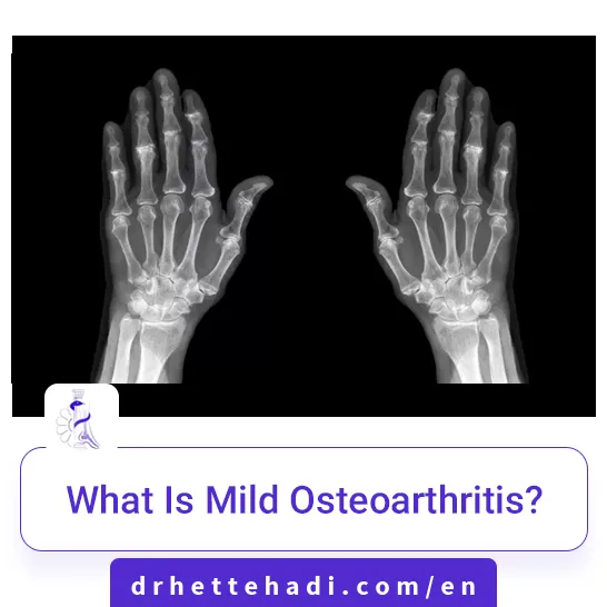 What Is Mild Osteoarthritis