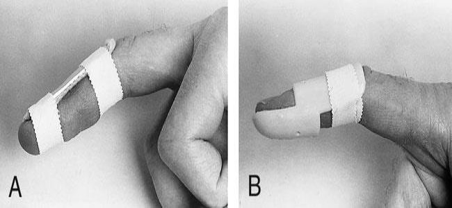 درمان غیر جراحی انگشت چکشی دست