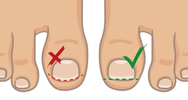 درمان ناخن در گوشت پا