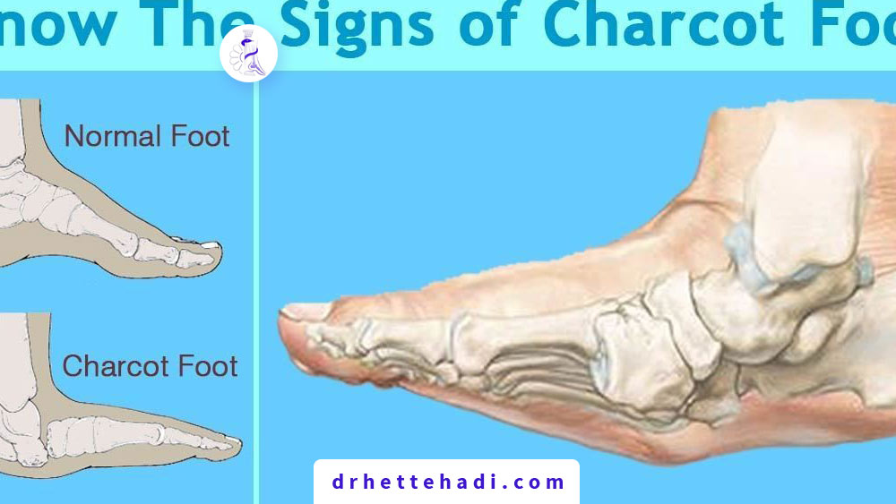 charcot foot and diabetes 1