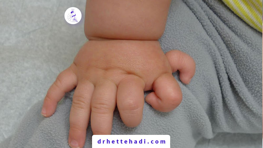 Polydactyly 1