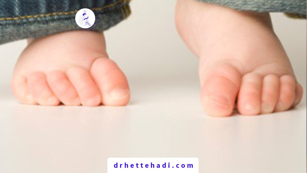 curly toes children 1