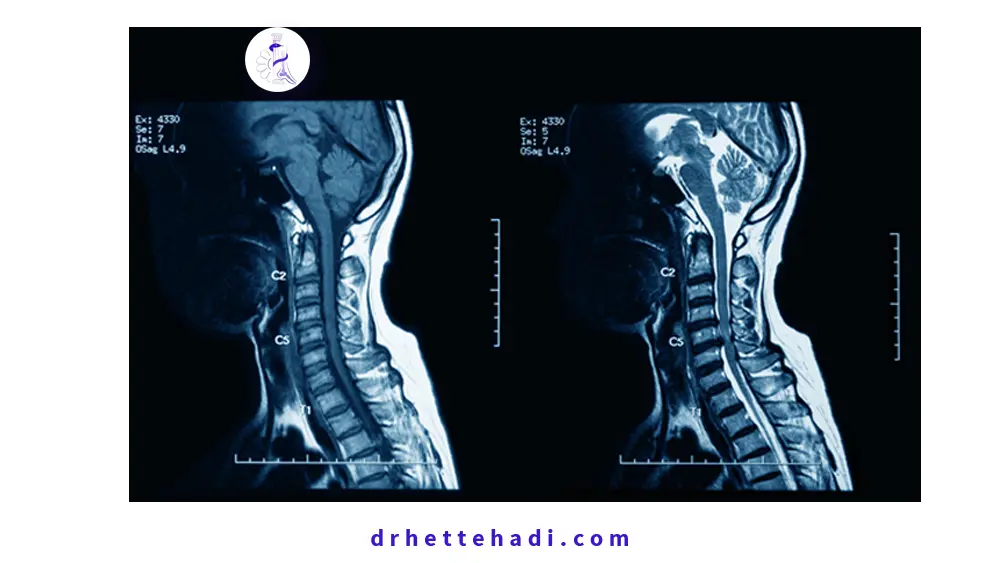 آرتروز گردن یا اسپوندیلوز گردنی-تشخیص